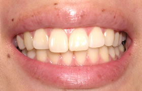 ���~�l�[�g�x�j�A���Ì�