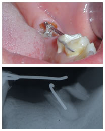 �C���v�����g���Ò�