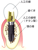 �C���v�����g